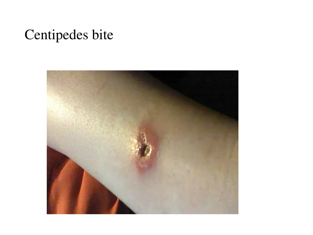 centipedes bite