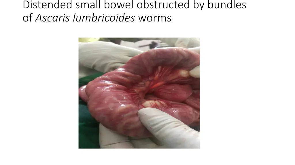 distended small bowel obstructed by bundles
