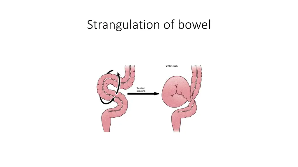 strangulation of bowel