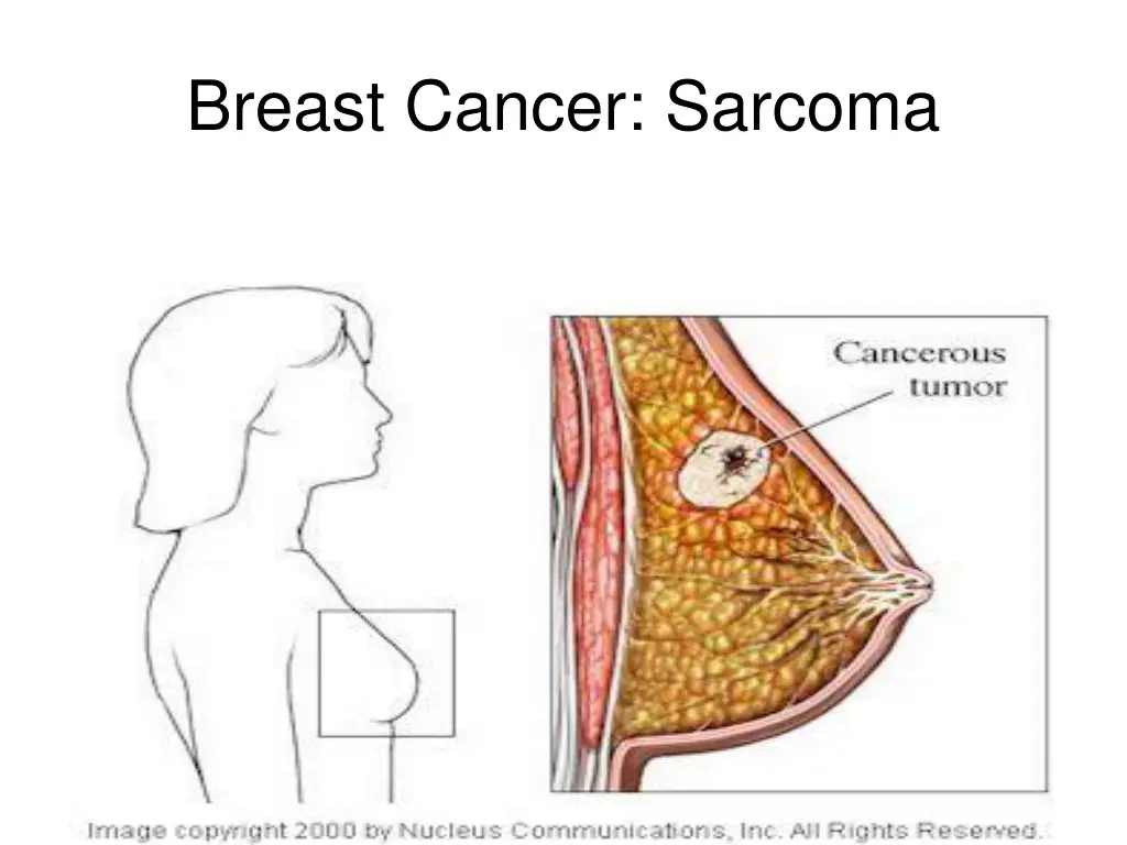breast cancer sarcoma
