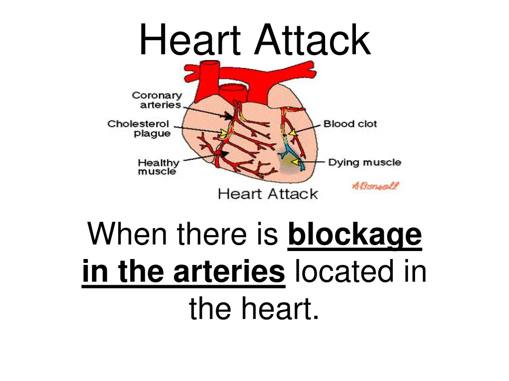 heart attack