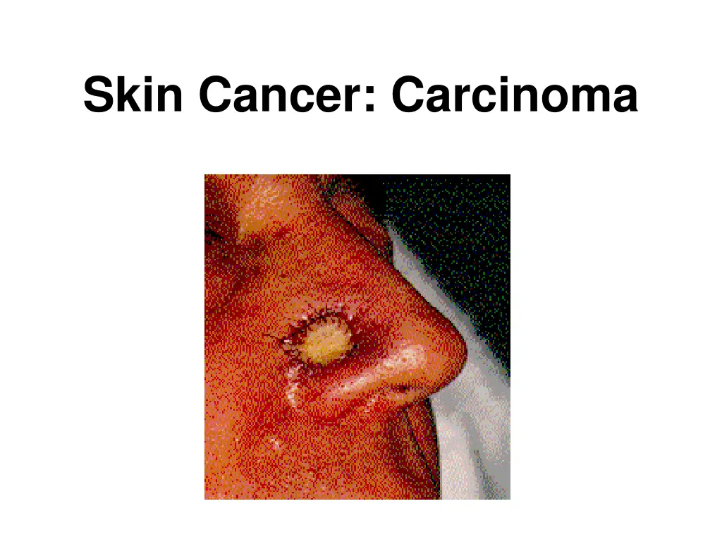 skin cancer carcinoma