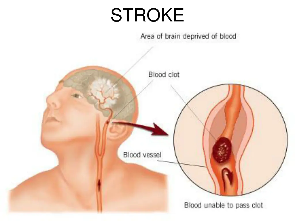 stroke 1