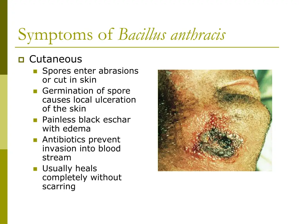symptoms of bacillus anthracis