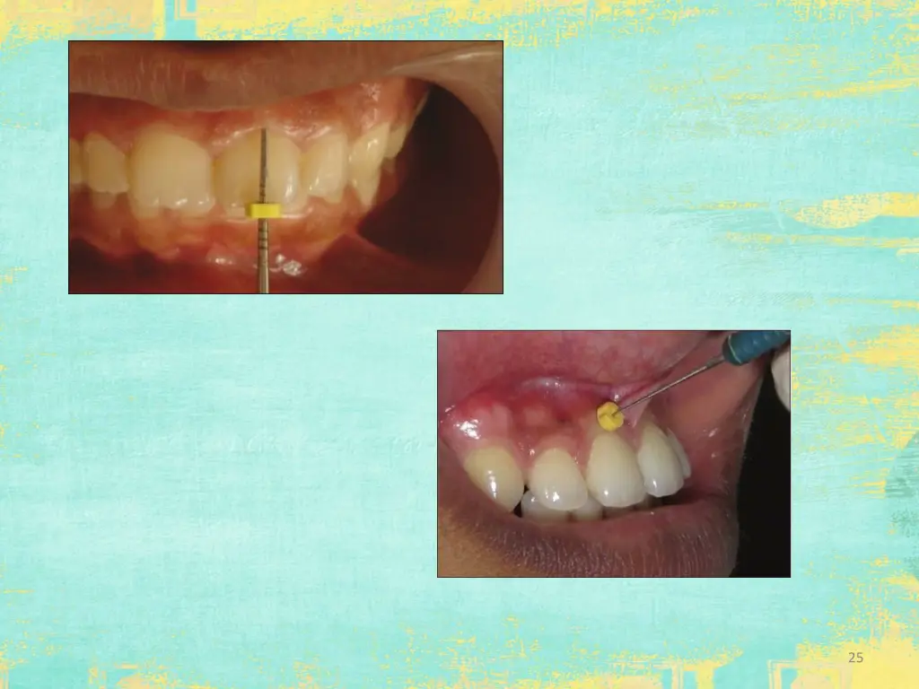 slide25