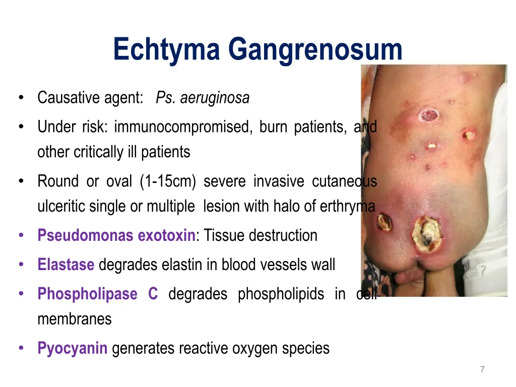 echtyma gangrenosum