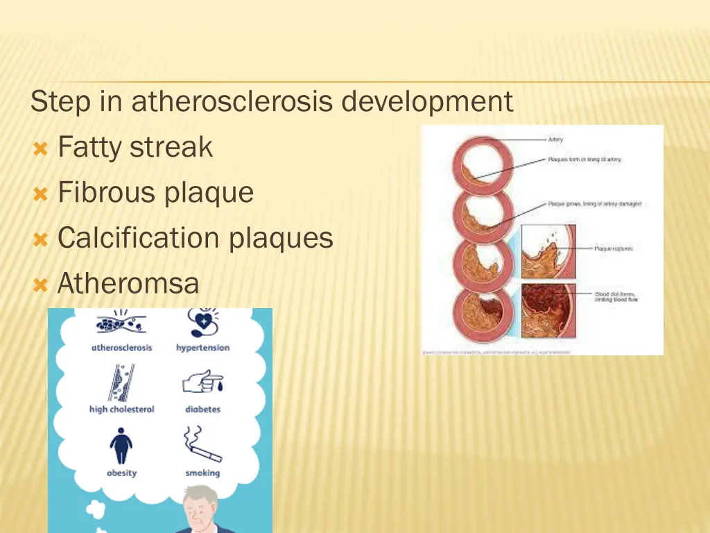 step in atherosclerosis development fatty streak