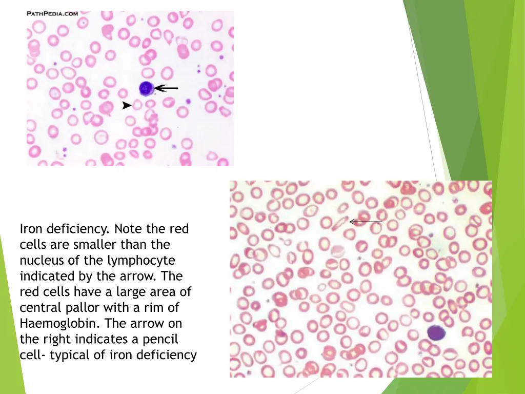 iron deficiency note the red cells are smaller