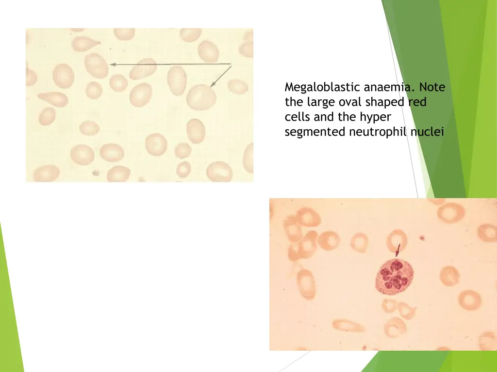 megaloblastic anaemia note the large oval shaped