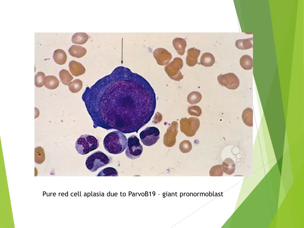 pure red cell aplasia due to parvob19 giant