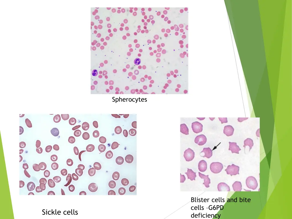 spherocytes