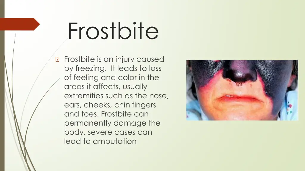 frostbite