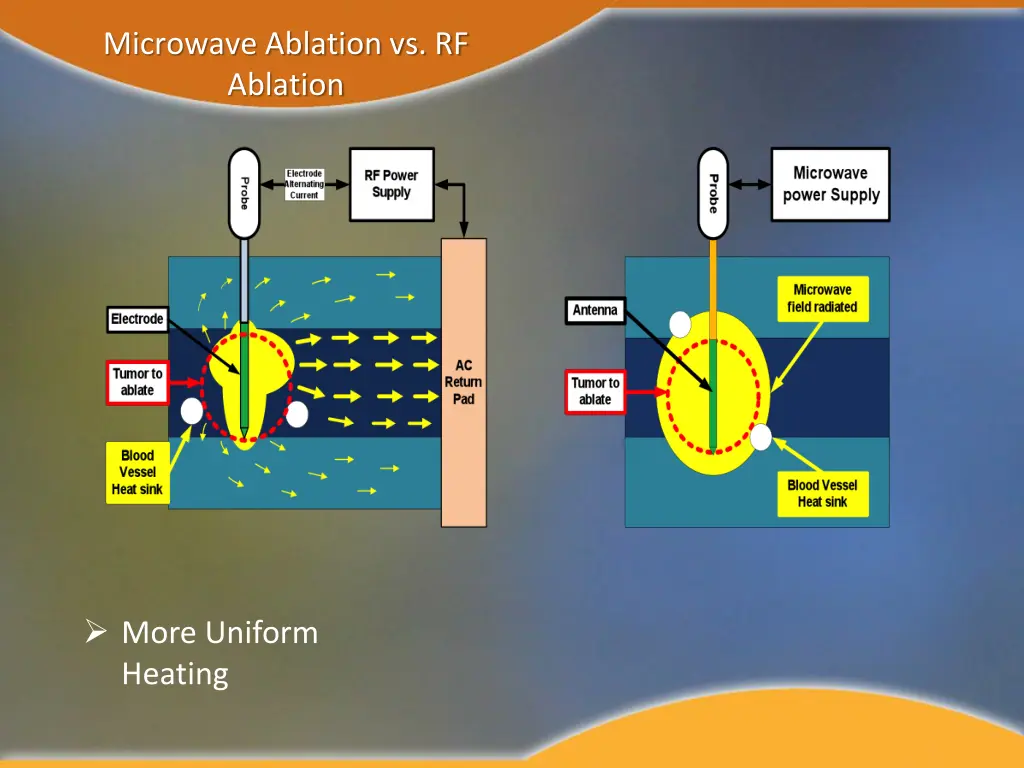 microwave ablation vs rf ablation 2