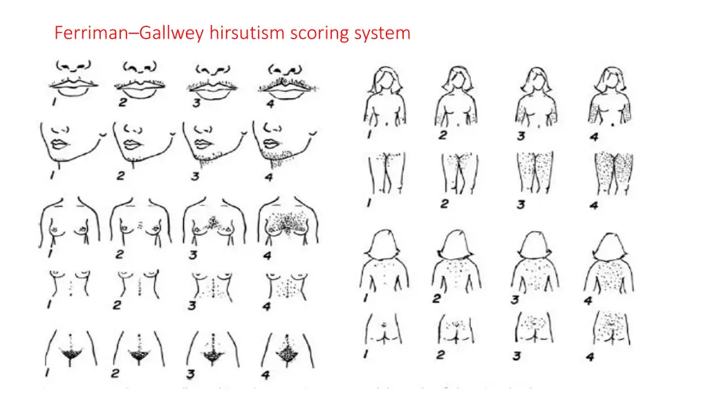 ferriman gallwey hirsutism scoring system