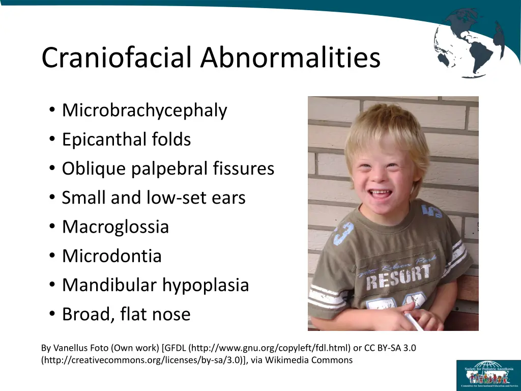 craniofacial abnormalities