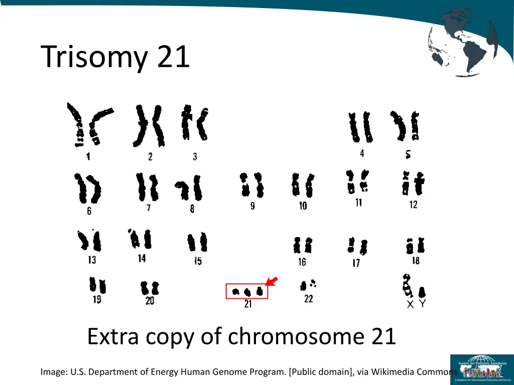 trisomy 21