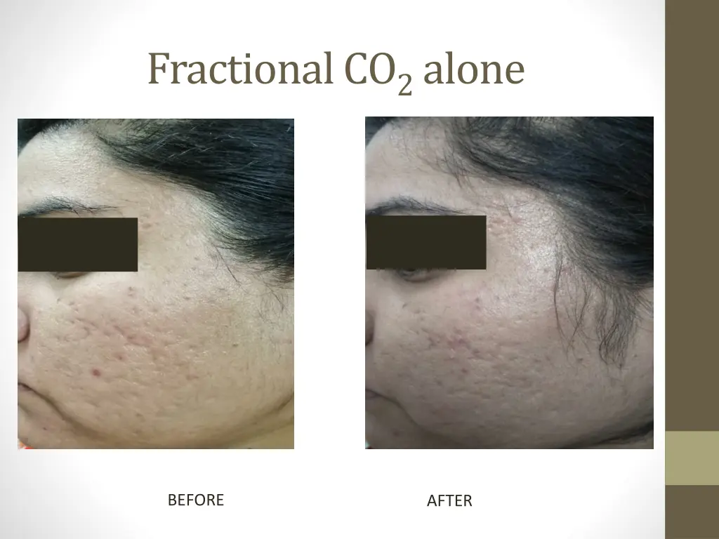 fractional co 2 alone