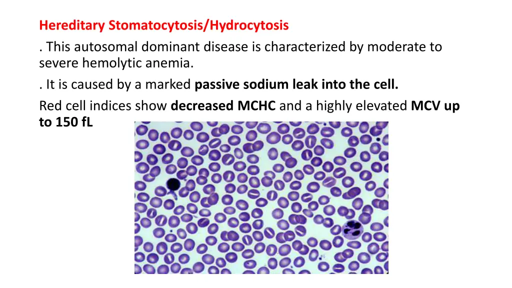hereditary stomatocytosis hydrocytosis this