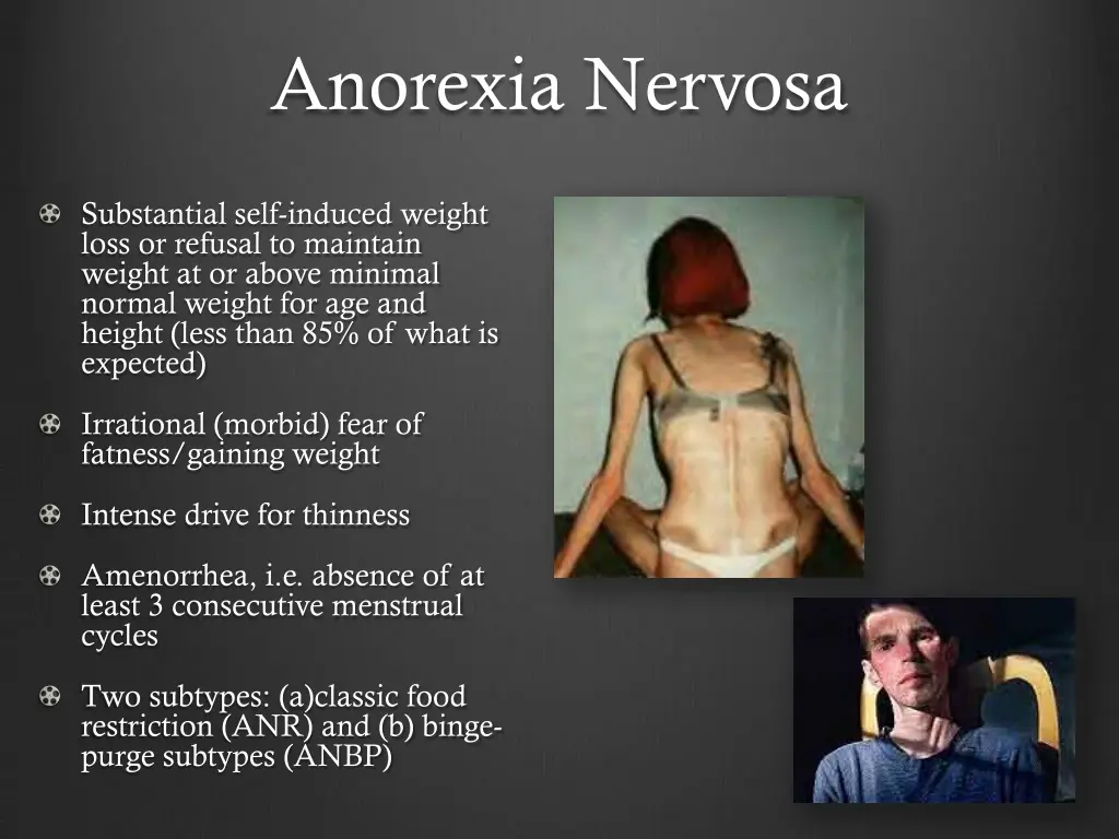anorexia nervosa