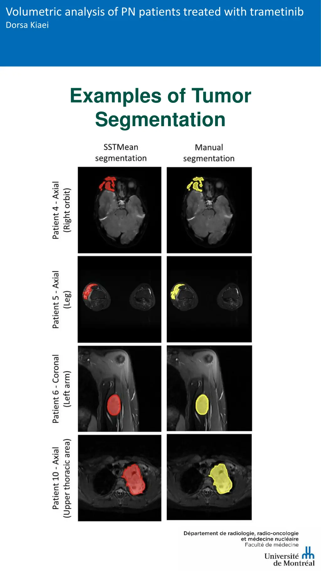 volumetric analysis of pn patients treated with 6