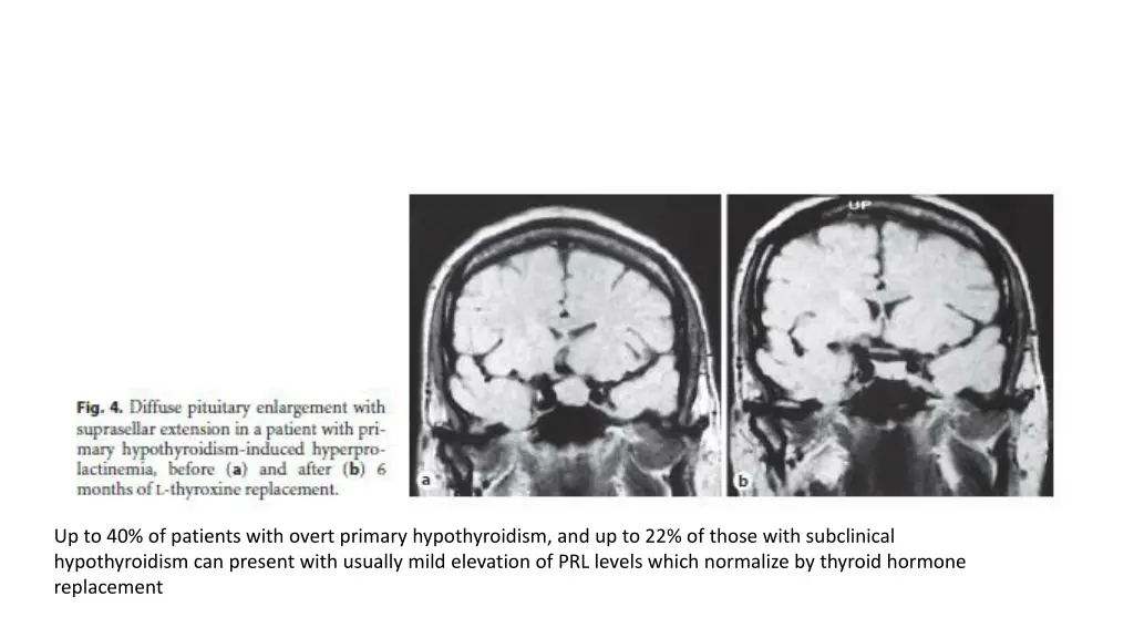 up to 40 of patients with overt primary