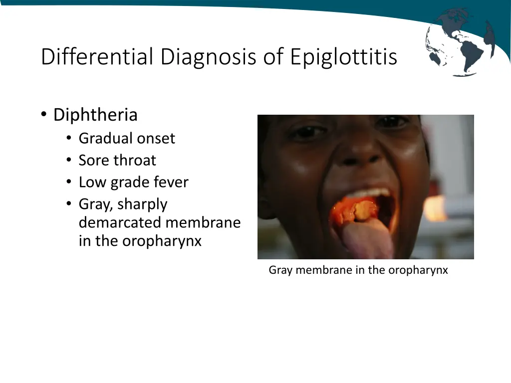 differential diagnosis of epiglottitis 4