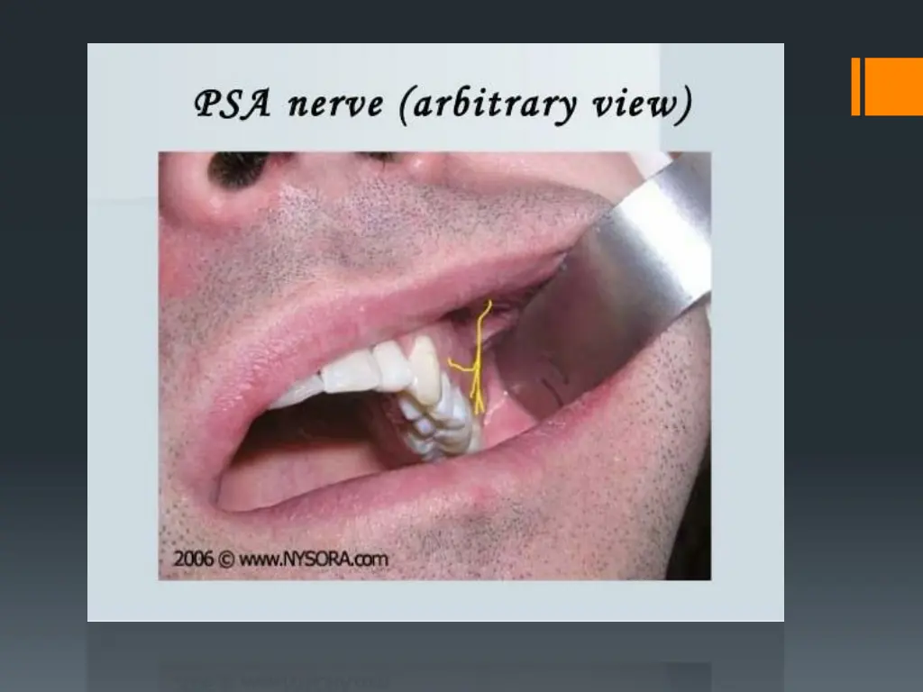 slide17