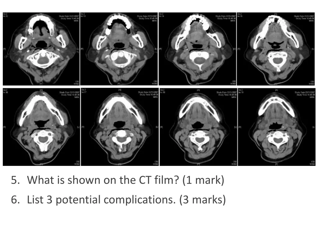 5 what is shown on the ct film 1 mark