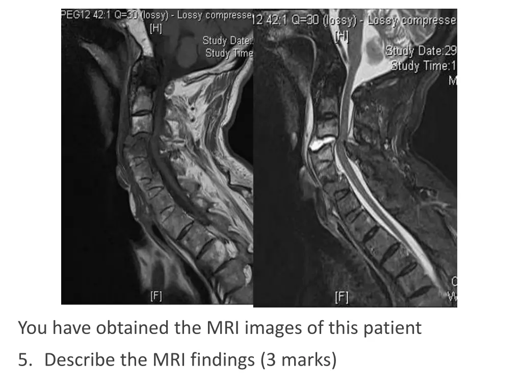 you have obtained the mri images of this patient