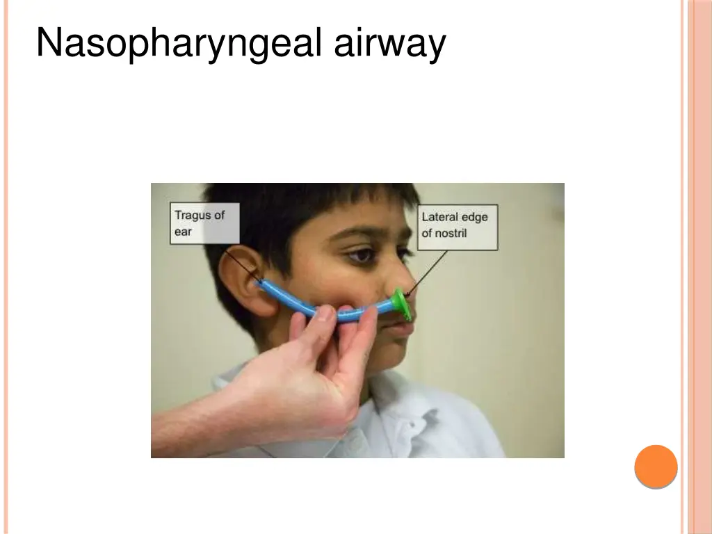 nasopharyngeal airway