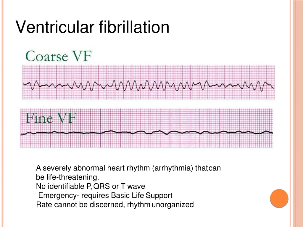 ventricular fibrillation