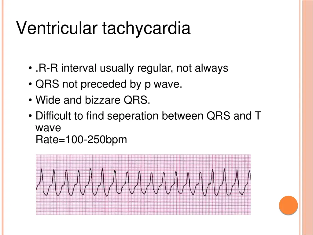 ventricular tachycardia