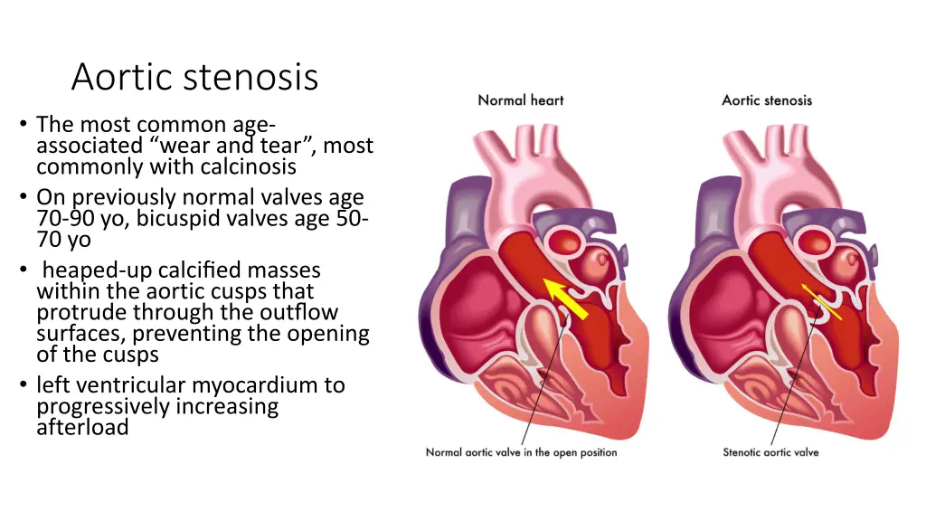 aortic stenosis the most common age associated