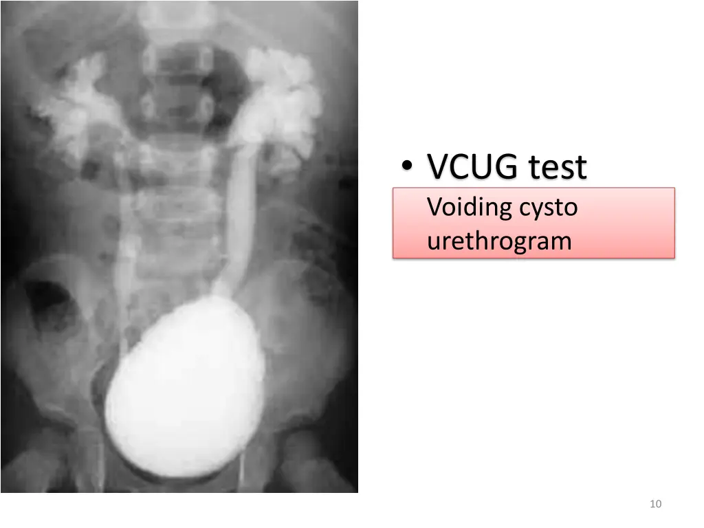 vcug test voiding cysto urethrogram