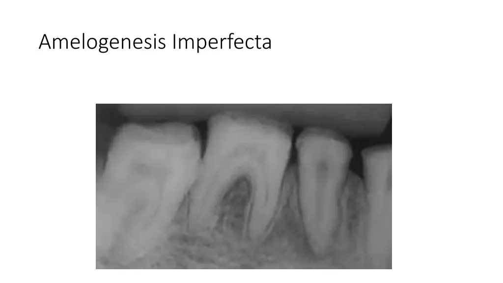 amelogenesis imperfecta