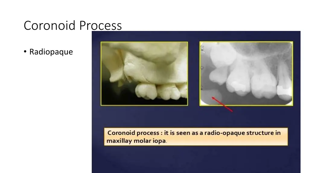 coronoid process