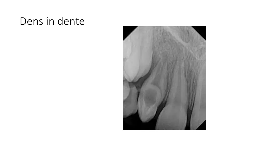 dens in dente