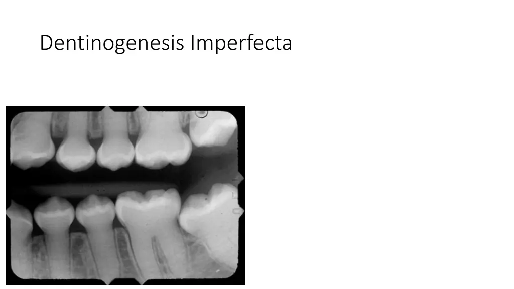 dentinogenesis imperfecta