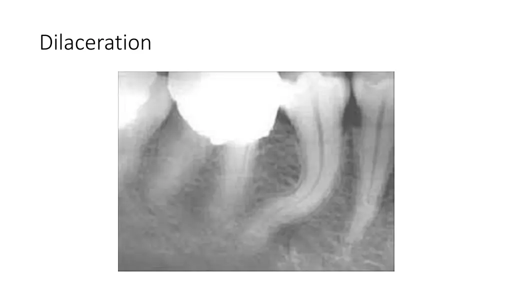 dilaceration
