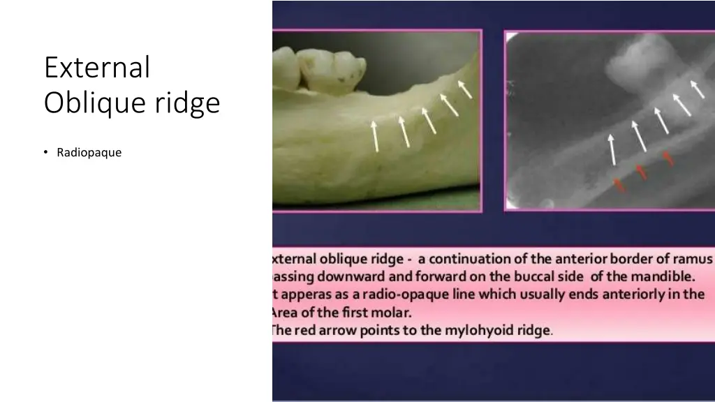 external oblique ridge