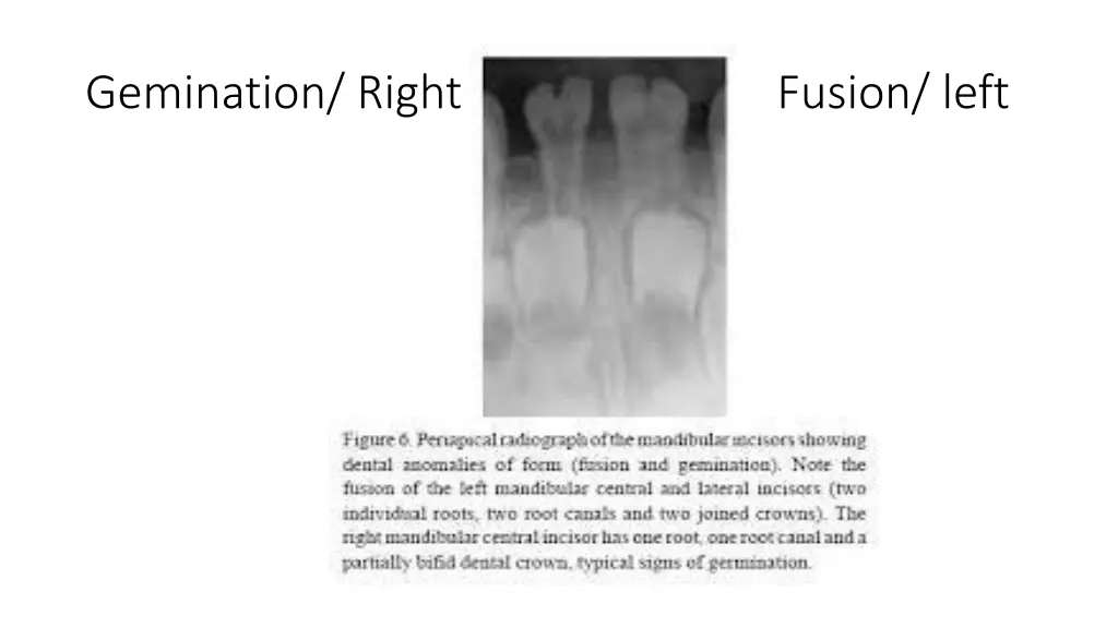 gemination right fusion left