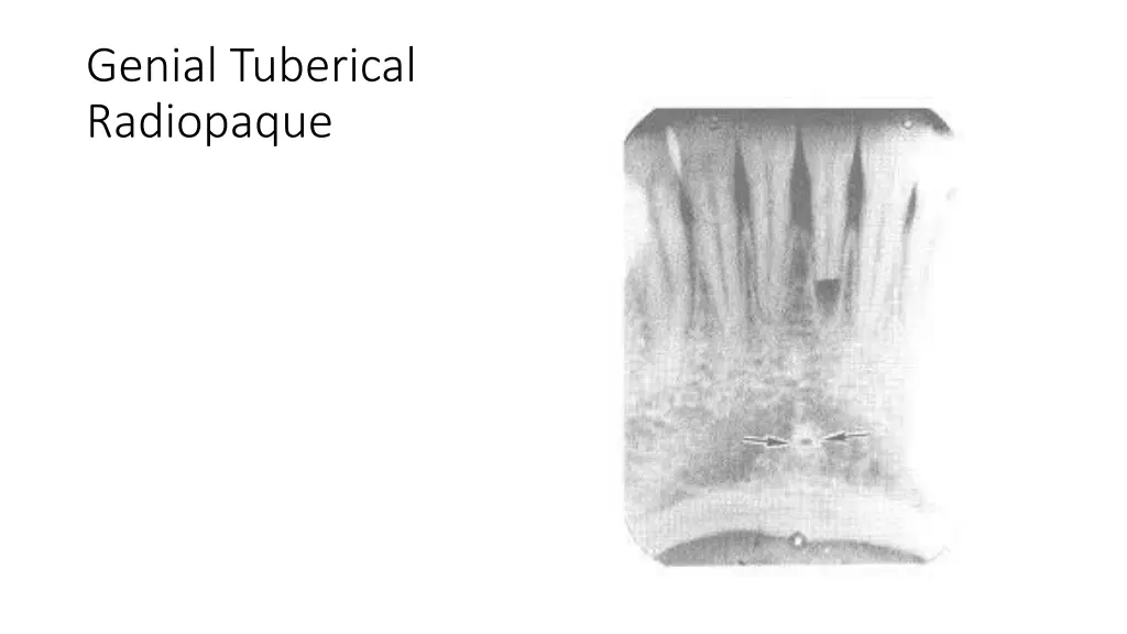 genial tuberical radiopaque