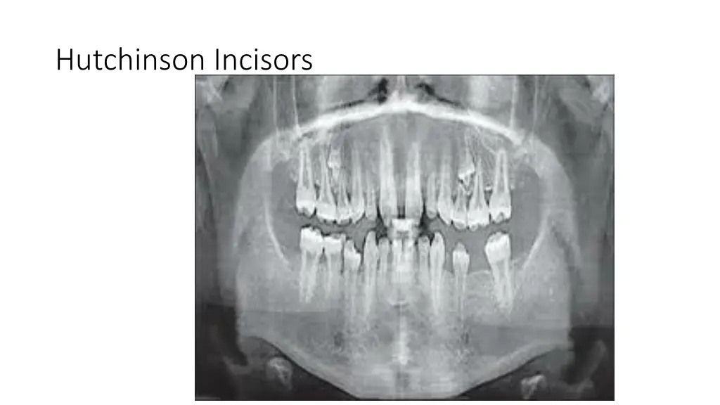 hutchinson incisors