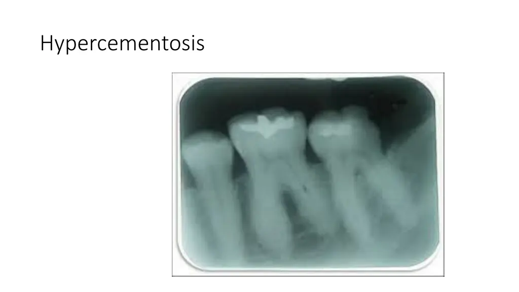 hypercementosis