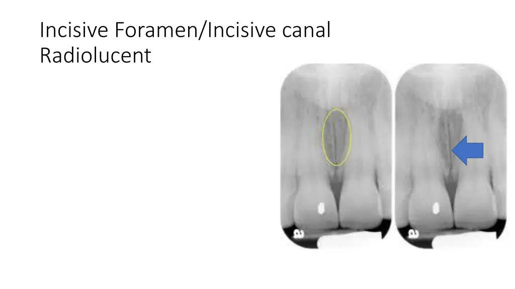 incisive foramen incisive canal radiolucent