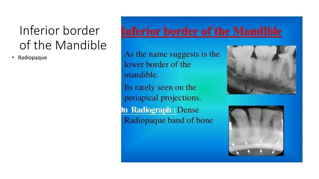 inferior border of the mandible radiopaque