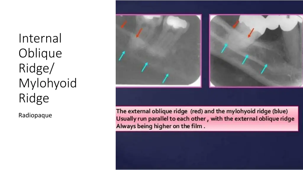 internal oblique ridge mylohyoid ridge