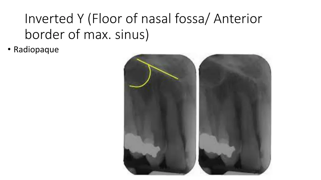 inverted y floor of nasal fossa anterior border