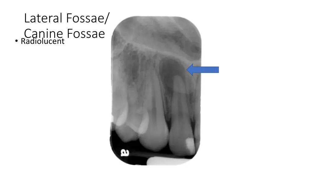 lateral fossae canine fossae radiolucent