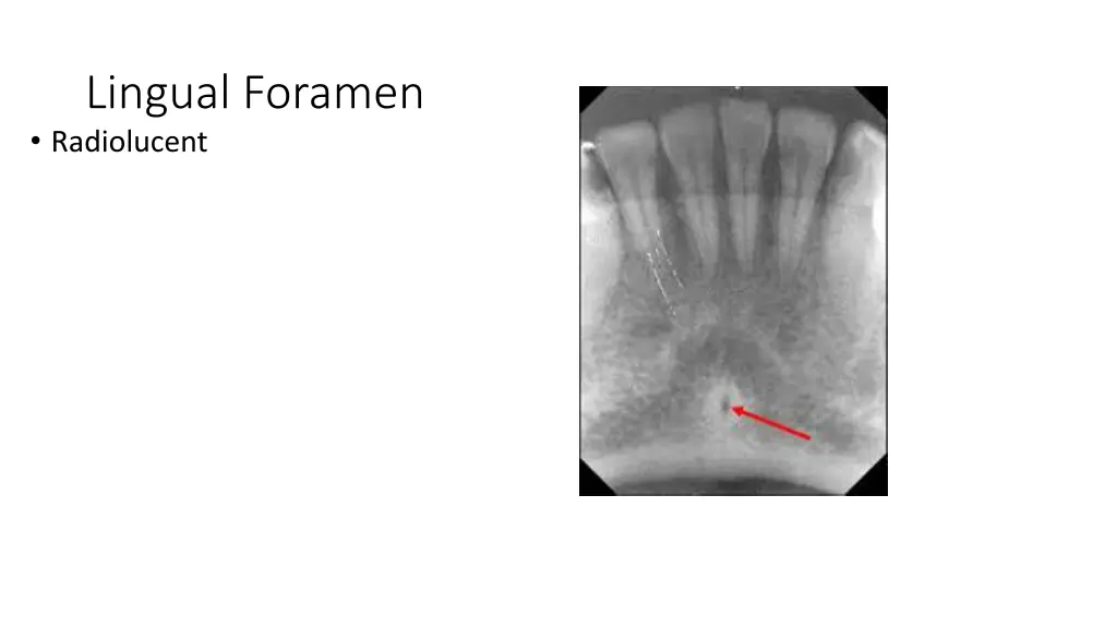 lingual foramen radiolucent